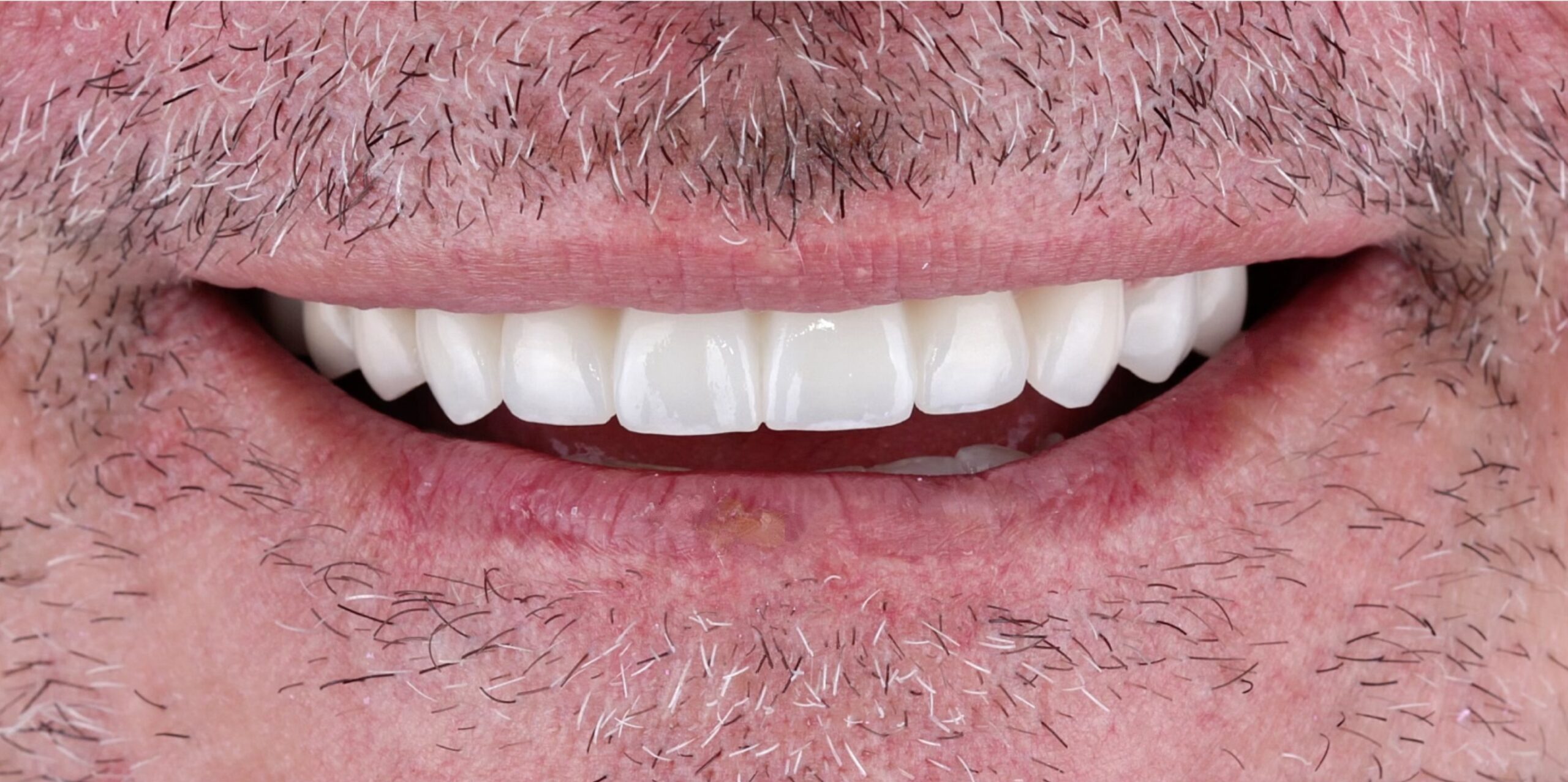 Copia de veneers smile tijuana 10