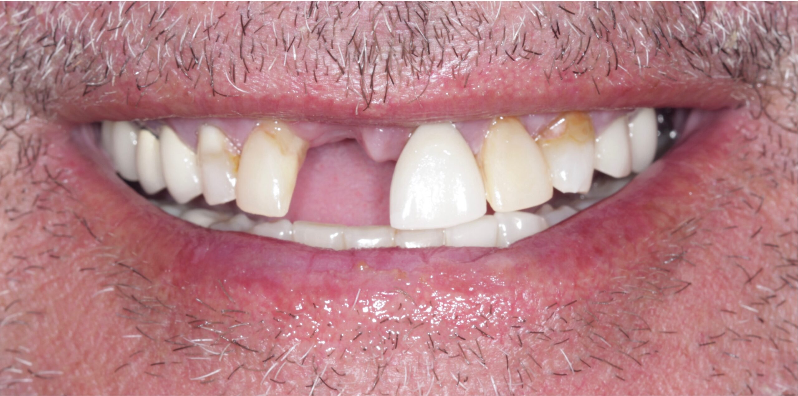 veneers smile tijuana 10